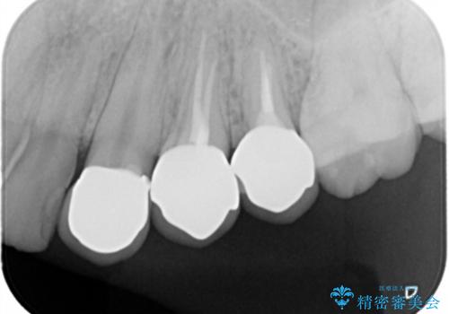 歯の水平・垂直的位置を整備したセラミッククラウン治療の治療後
