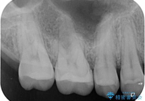 虫歯をしっかり治したい セラミックインレーの治療後