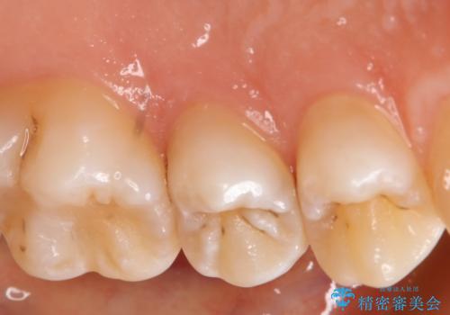 虫歯を治療したい　セラミックインレーの治療前