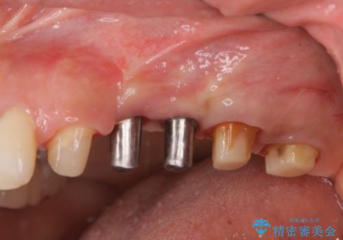 銀歯を外してのインプラント・セラミック治療の治療中