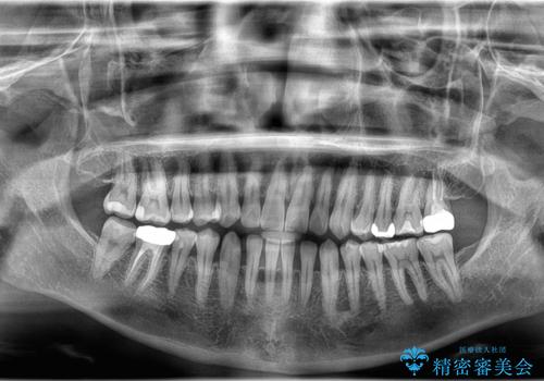 すきっ歯・切端咬合・空隙歯列|インビザラインで11ヵ月で治療完了の治療前