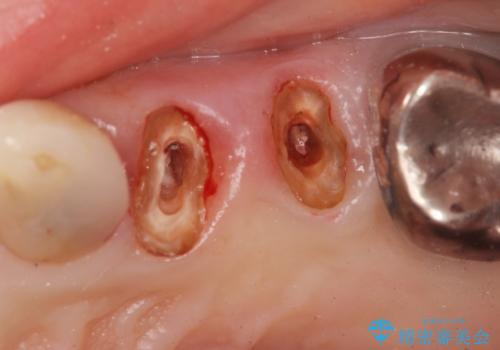 銀歯を外してのインプラント・セラミック治療の治療前