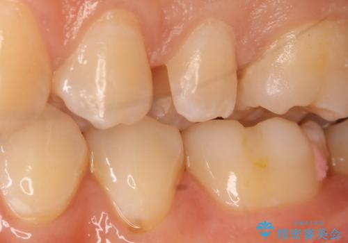 虫歯を治療したい セラミックインレーの治療中