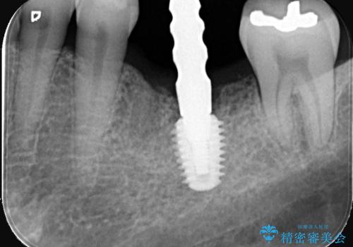 根尖性歯周炎|分岐部病変|パーフォレーション|インプラントで治療の治療後