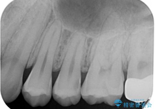 虫歯を治療したい セラミックインレーの治療前