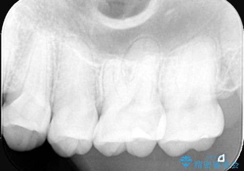 2回で完了した奥歯のセラミック修復の治療前
