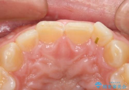 前歯が欠けたので綺麗にしたい　オールセラミッククラウンの治療前