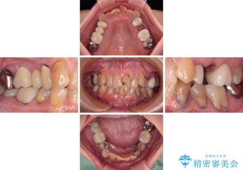長年気になっていた前歯　矯正治療と補綴治療による審美歯科治療の治療前