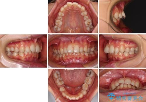 欠損や残存乳歯、深い咬み合わせ ワイヤー矯正で咬合改善の治療前