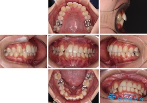 【モニター】閉じにくい前歯とクロスバイト ワイヤー装置での抜歯矯正の治療前