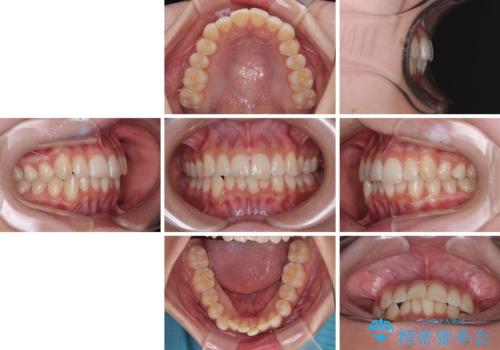 気になる前歯と咬み合わせを改善 インビザライン・モデレートの治療前