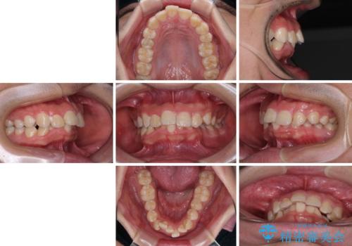 左右に顎がずれた咬み合わせ ワイヤー矯正で咬み合わせを改善の治療前