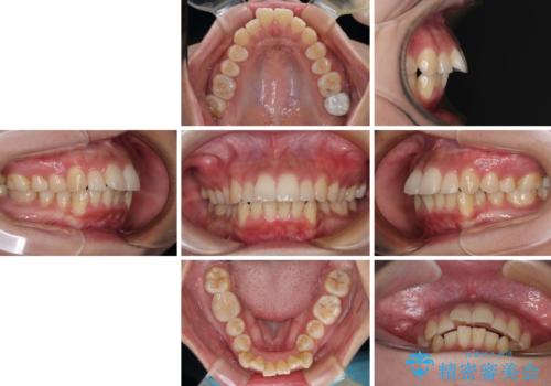 【モニター】唇が閉じにくい　ワイヤー装置での抜歯矯正の治療前