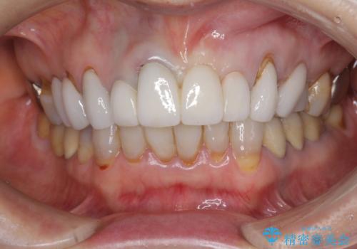 [ セラミック治療 ]  歯ぐきの際の黒ずみを改善したいの治療後