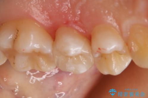 虫歯を治療したい セラミックインレーの治療後