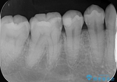 【セラミックインレー】歯がたまーにしみるの治療前