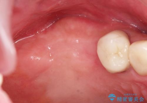 奥歯でしっかりと咬みたい 咬合機能をしっかりと回復するインプラント治療の治療前