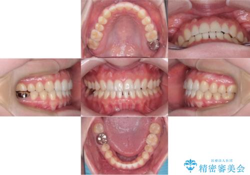 すきっ歯・切端咬合・空隙歯列|インビザラインで11ヵ月で治療完了の治療後