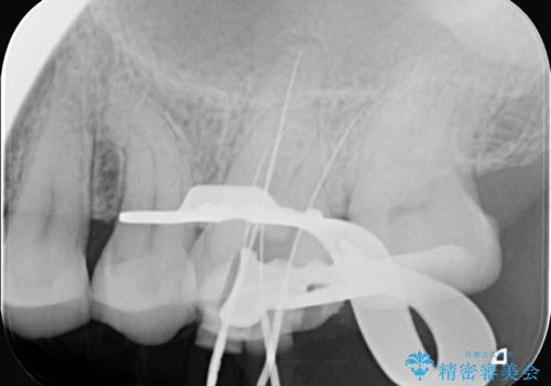奥歯の痛みを根本から解消し、クラウンで歯の強度を回復の治療中