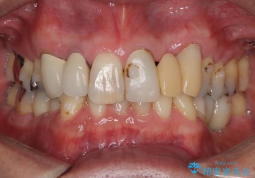 【セラミッククラウン】【エクストリュージョン】抜歯はしたくないの治療前