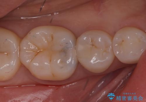 【セラミックインレー】歯がたまーにしみるの治療前