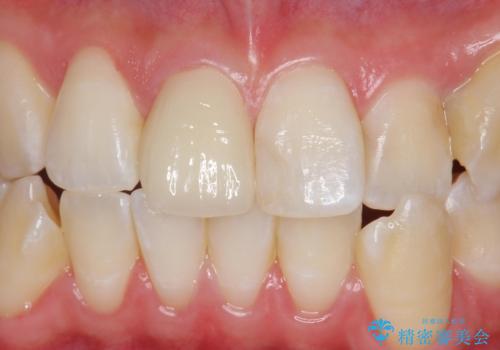 前歯の色が気になる。オールセラミッククラウンでのやり替えの症例 治療後
