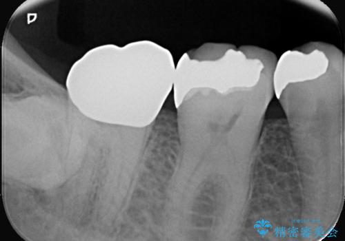 欠けた奥歯の強度を向上!PGAクラウンで安心の咬み心地を再建の治療後