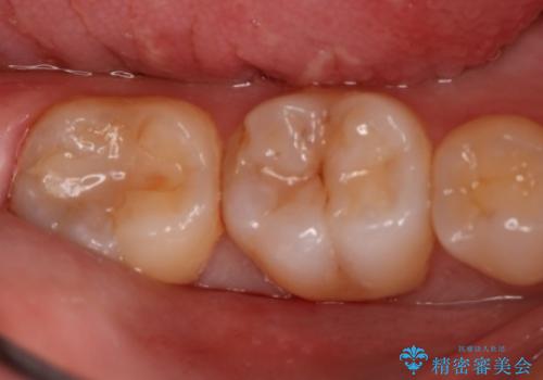 奥歯の治療をしたい　セラミックインレーの治療前