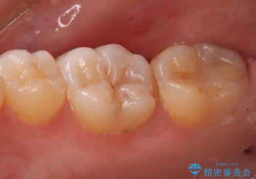 奥歯の治療をしたい　セラミックインレーの治療前
