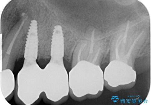銀歯を外してのインプラント・セラミック治療の治療後