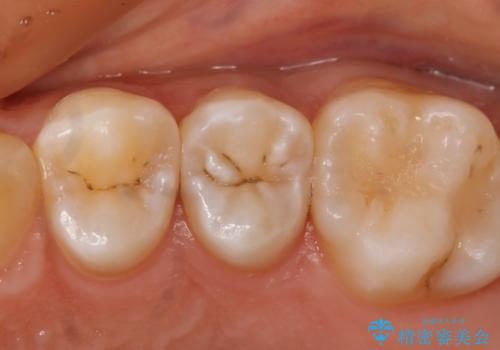 虫歯を治療したい セラミックインレーの治療前