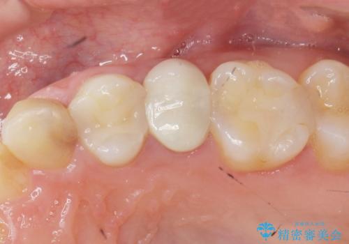 歯の水平・垂直的位置を整備したセラミッククラウン治療の治療後