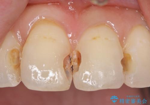 前歯の劣化したコンポジットレジン修復をセラミッククラウンへの治療中