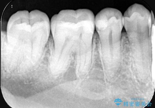 【セラミックインレー】歯がたまーにしみるの治療後