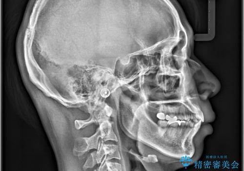 正中離開・クロスバイト・すきっ歯・叢生|インビザラインで治療の治療後