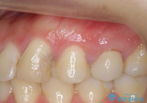 歯の水平・垂直的位置を整備したセラミッククラウン治療の症例 治療前