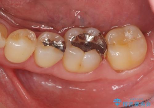 銀歯を外してのセラミック治療の症例 治療前