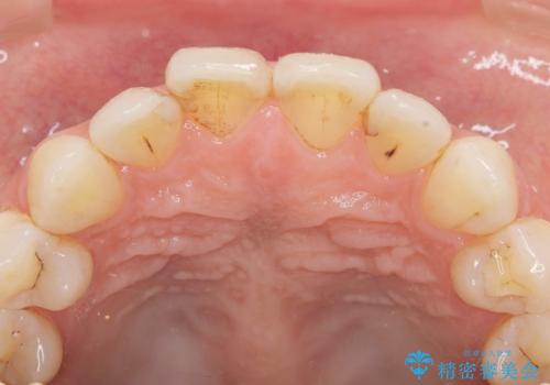 前歯の劣化したコンポジットレジン修復をセラミッククラウンへの治療前