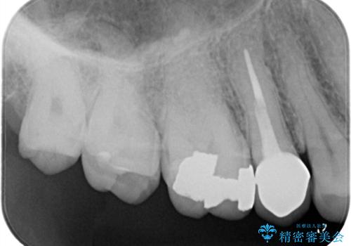 奥歯の銀歯を美しく一新!歯の破折を防ぐセラミッククラウンの治療前