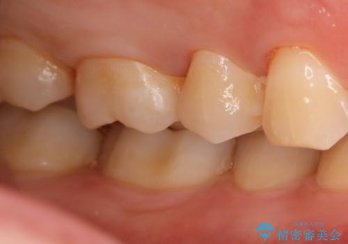 虫歯をしっかり治したい セラミックインレーの治療前