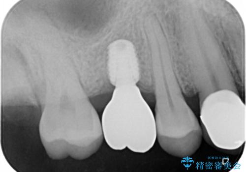 歯を入れたい　インプラント+セラミッククラウンの治療後
