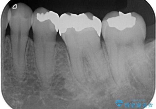 話すときに銀歯が見えて気になる　セラミックでキレイに治す!の治療前