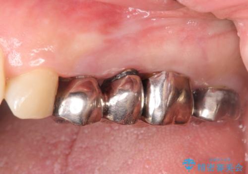 銀歯を外してのインプラント・セラミック治療の症例 治療前