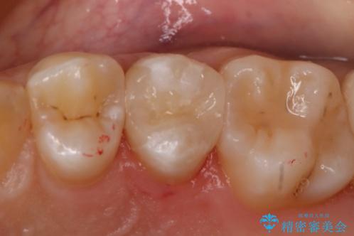 虫歯を治療したい　セラミックインレーの症例 治療後