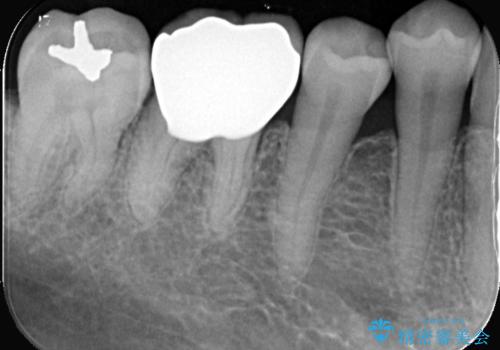 銀歯を白くしたい!|オールセラミッククラウンで審美回復の治療後
