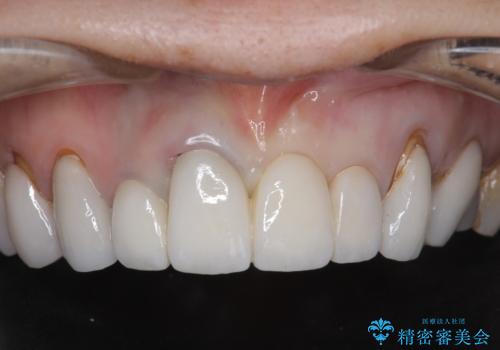 [ セラミック治療 ]  歯ぐきの際の黒ずみを改善したいの症例 治療後