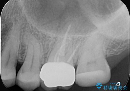 奥歯の痛みを根本から解消し、クラウンで歯の強度を回復の治療後