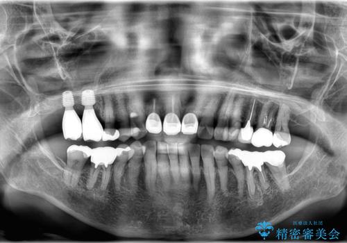 重度歯周病で失った奥歯2本を、抜歯即時インプラントで早期回復の治療後