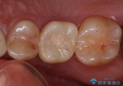 歯を入れたい インプラント+セラミッククラウンの治療後