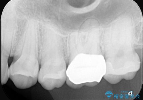 2回で完了した奥歯のセラミック修復の治療後